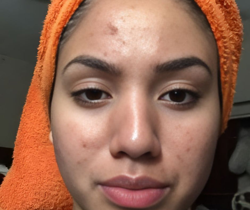 Before - Dark spots se nijaat