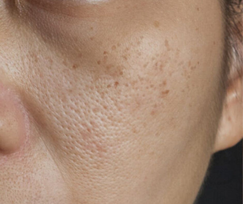 Before - Smooth & Clear Skin