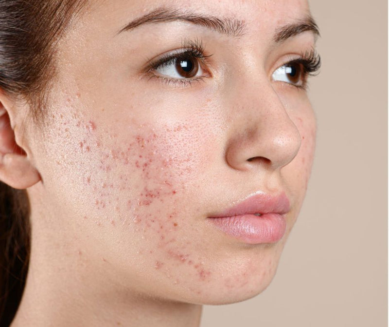 Before - Clear Acne-Free Skin